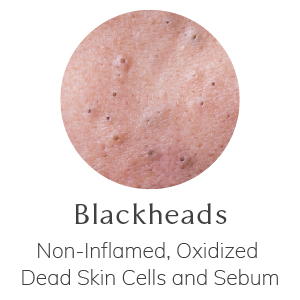 Blackheads - Non-Inflamed, Oxidized Dead Skin Cells, and Sebum