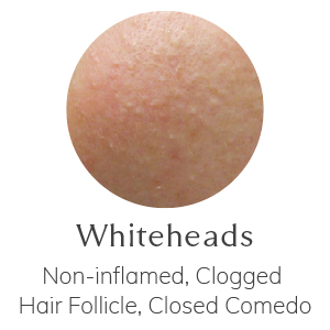 Whiteheads - Non-inflamed, Clogged Hair Follicle, Closed Comedo