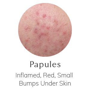 Papules - Inflamed, Red, Small Bumps Under Skin