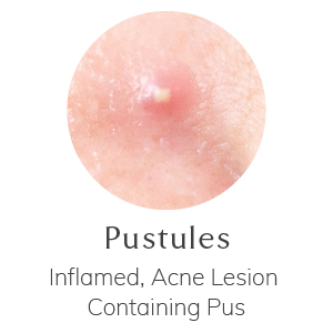 Pustule - Inflamed, Acne Lesion Containg Pus