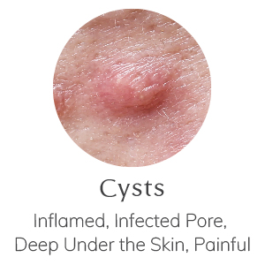 Cysts - Inflamed, Infected Pore, Deep Under the Skin, Painful
