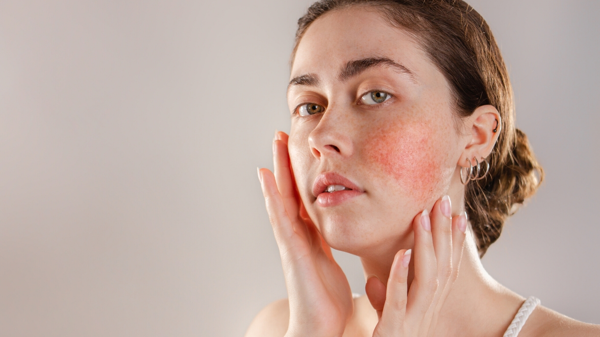 A woman with rosacea looks at the camera with her hands touching her face and neck.