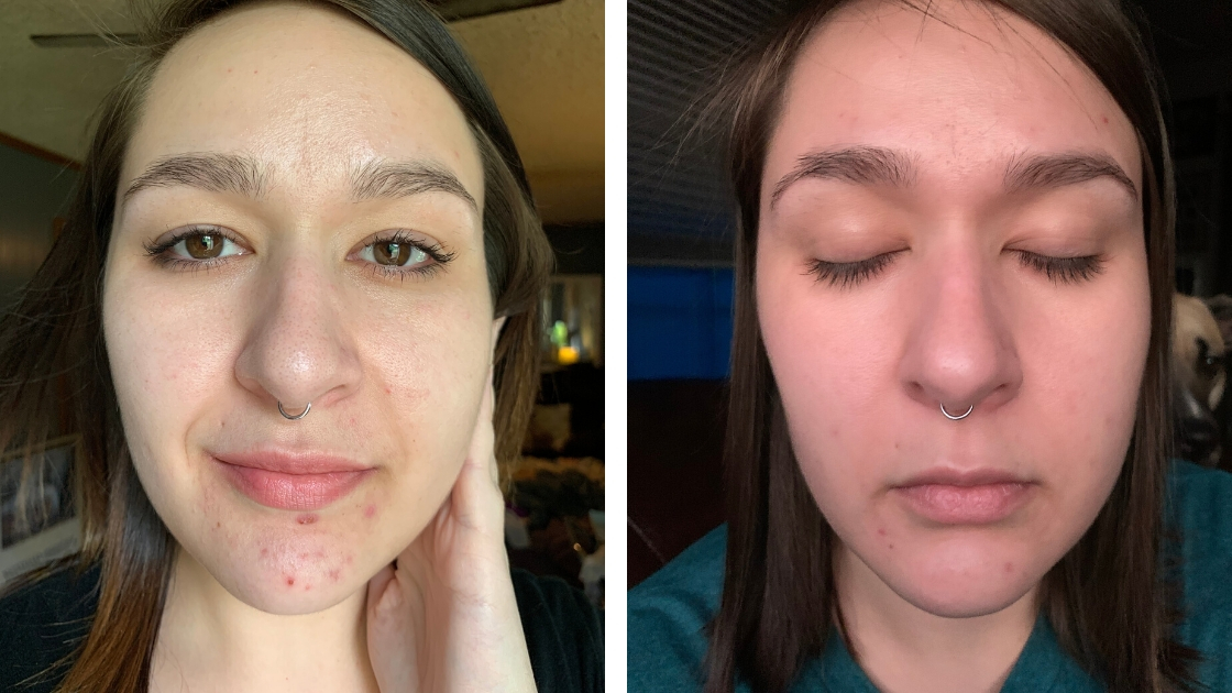 photos of a woman with hormonal breakouts on her chin in the before image and clear skin in her after image
