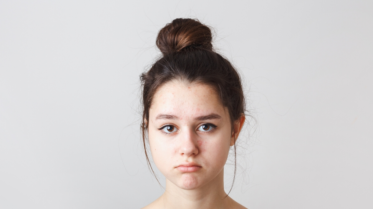 Girl with Maturation Arrest Acne
