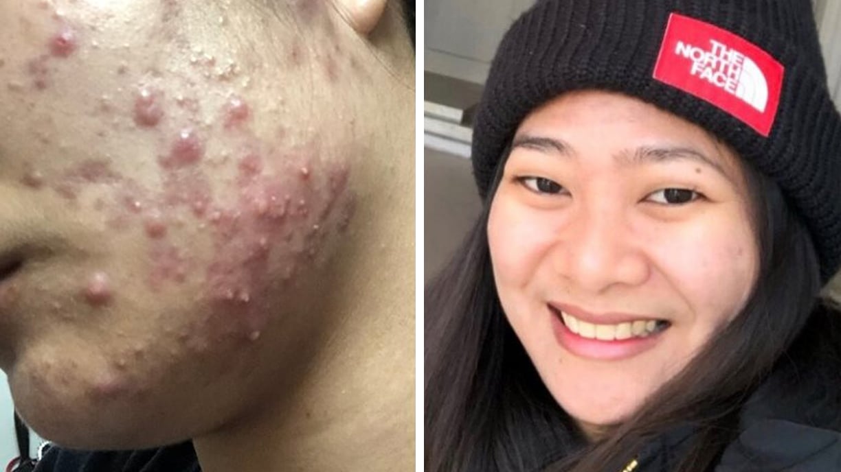 before and after image of a woman with cystic acne in her before image and clear skin in her after image