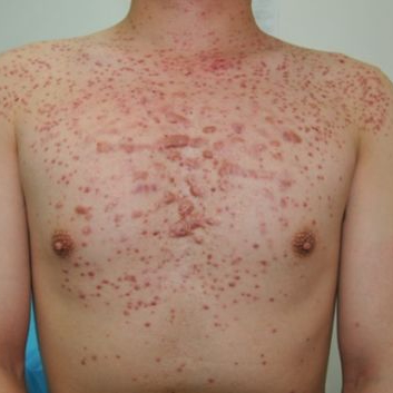 A man's chest covered in fungal folliculitis.