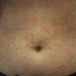 Pseudomonas Folliculitis - (also known as Hot Tub rash) 
