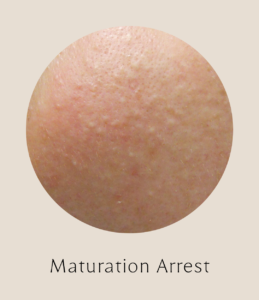 Image of Maturation Arrest Acne