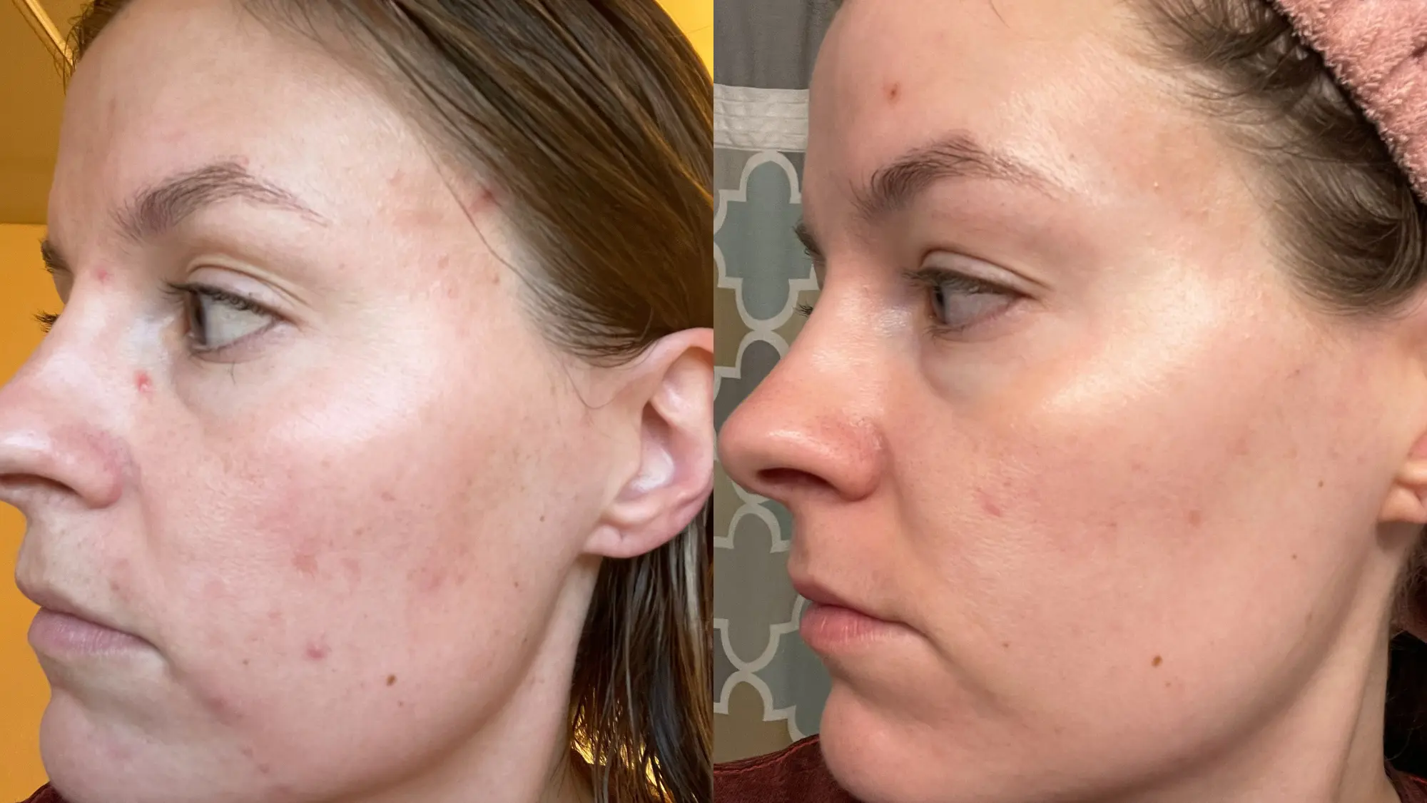 Megan Weddle Before and After (side profile looking to left)